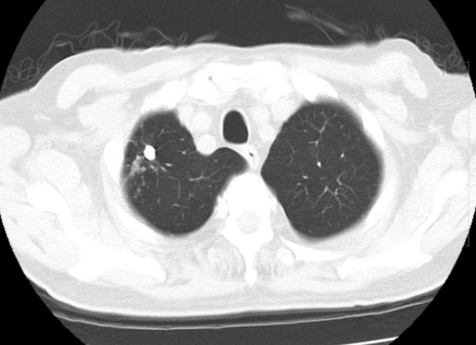 肺結節知識 肺結節知識