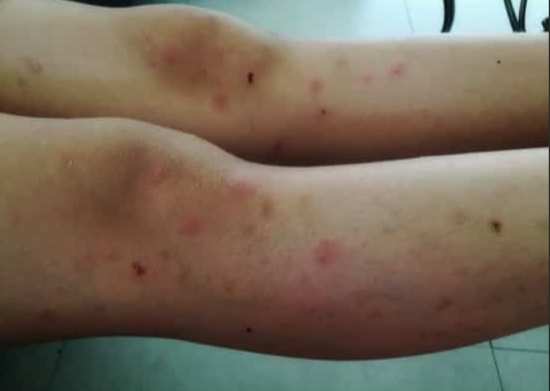 結節性癢疹治療 結節性癢疹治療