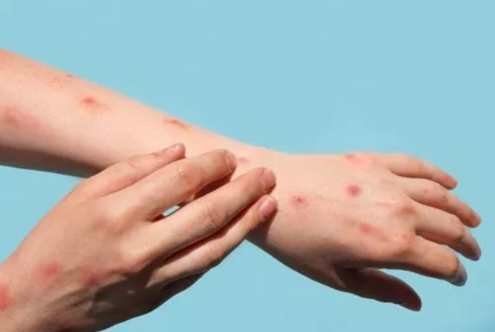 結節性癢疹原因 結節性癢疹原因