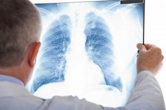 毛玻璃結節原因