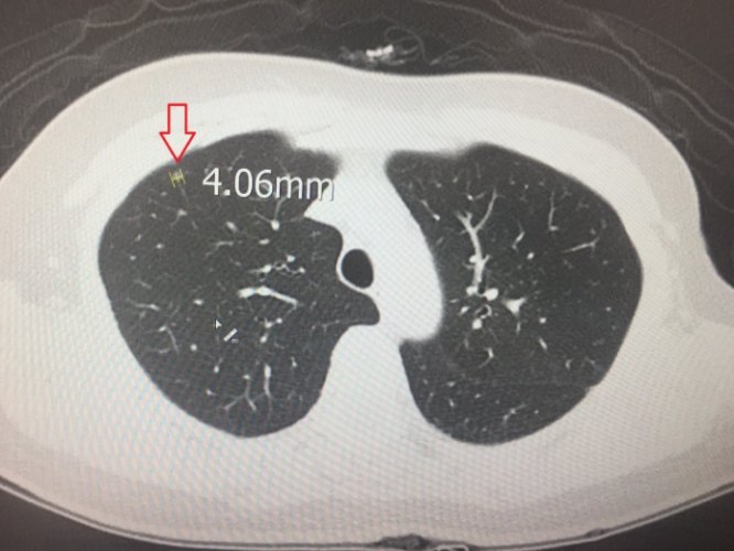 毛玻璃結節生長速度