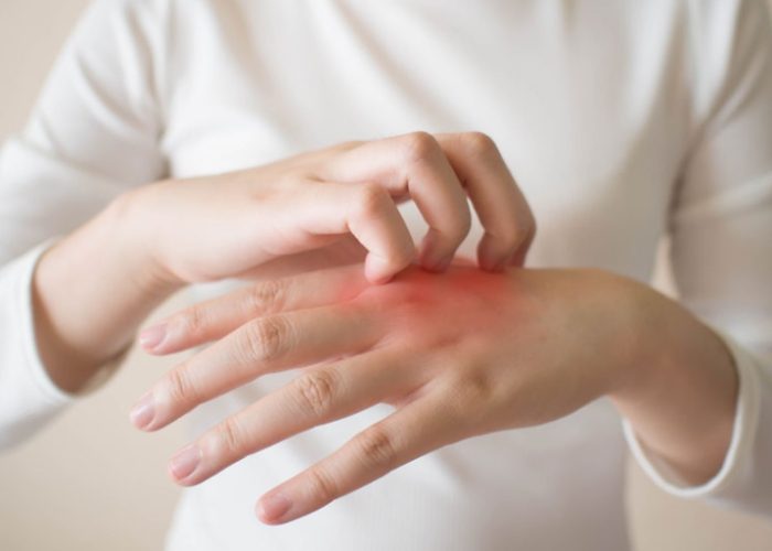 結節性癢疹治療 結節性癢疹治療