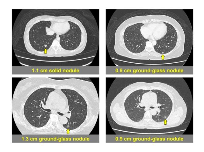 毛玻璃結節原因 毛玻璃結節原因