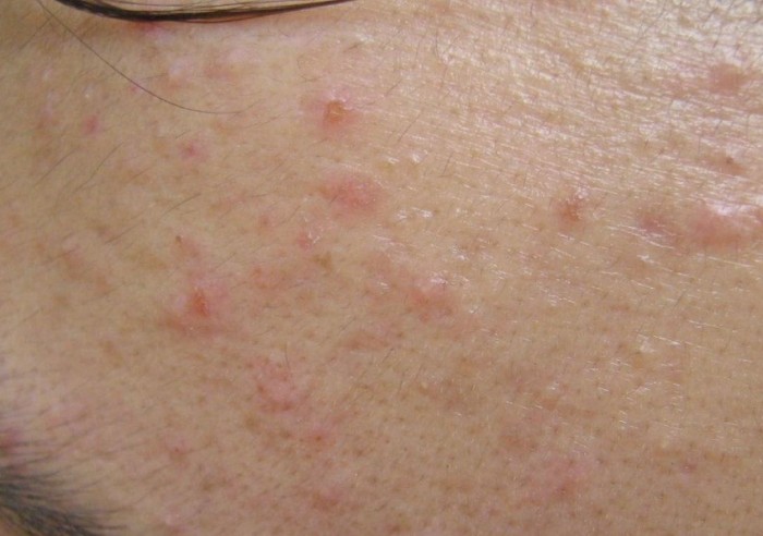 結節型痘痘原因