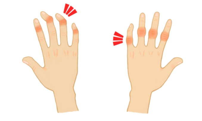 手指關節結節原因