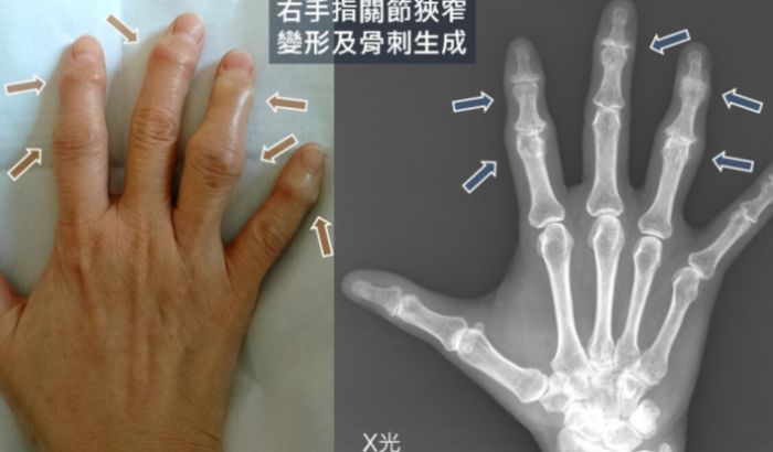 手指關節結節治療