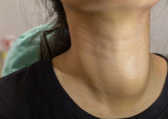 甲狀腺結節腫症狀要看什麼科 甲狀腺結節腫症狀要看什麼科