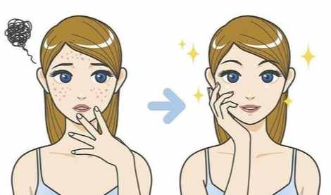 結節型痘痘怎麼辦