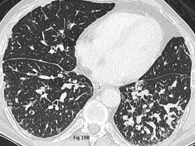 肺結節原因 肺結節原因