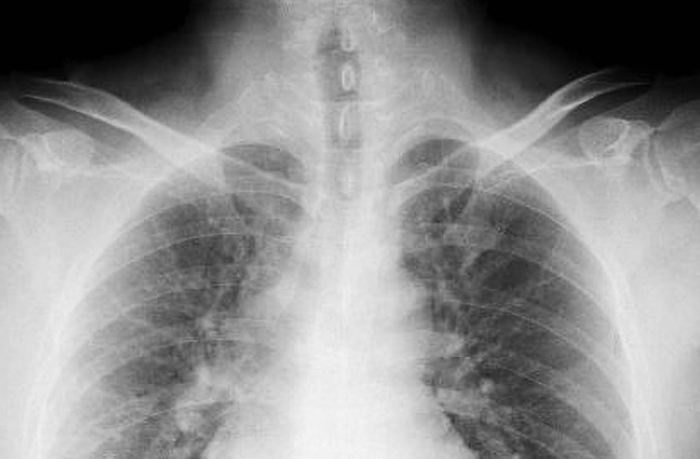 肺部結節症狀 肺部結節症狀