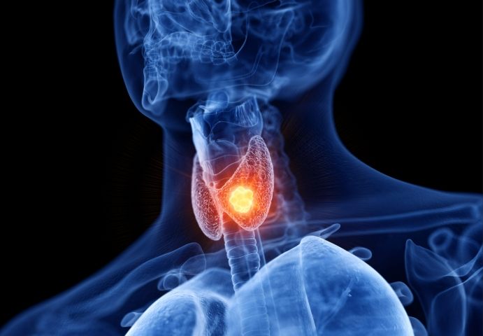 甲狀腺結節鈣化症狀