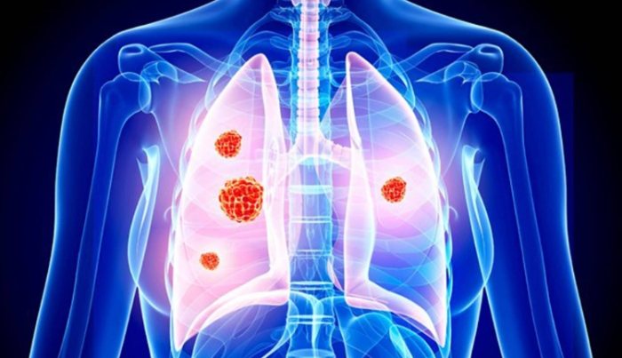 肺結節怎麼治療 肺結節怎麼治療