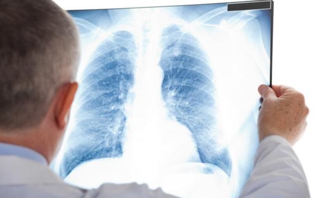 肺部毛玻璃樣結節需開刀 肺部毛玻璃樣結節需開刀