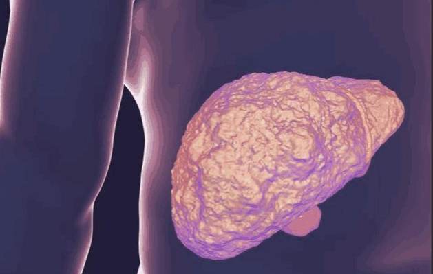 肝結節怎麼辦 肝結節怎麼辦