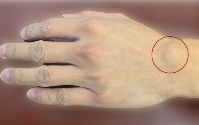 手指關節結節症狀