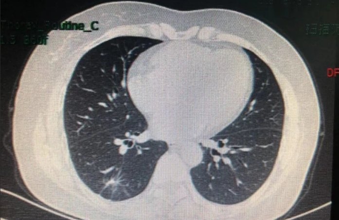 肺結節原因 肺結節原因