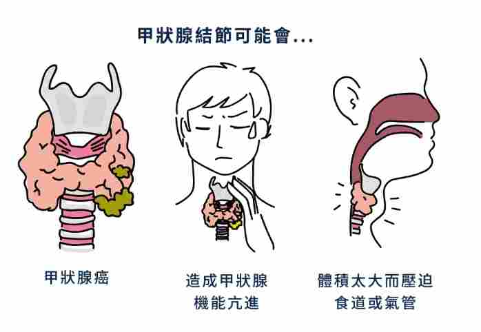 甲狀腺結節鈣化原因