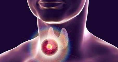 甲狀腺結節穿刺副作用