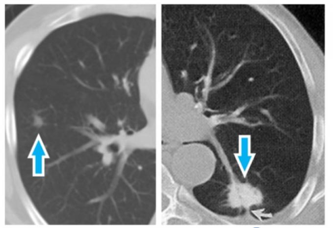 毛玻璃結節轉移 毛玻璃結節轉移