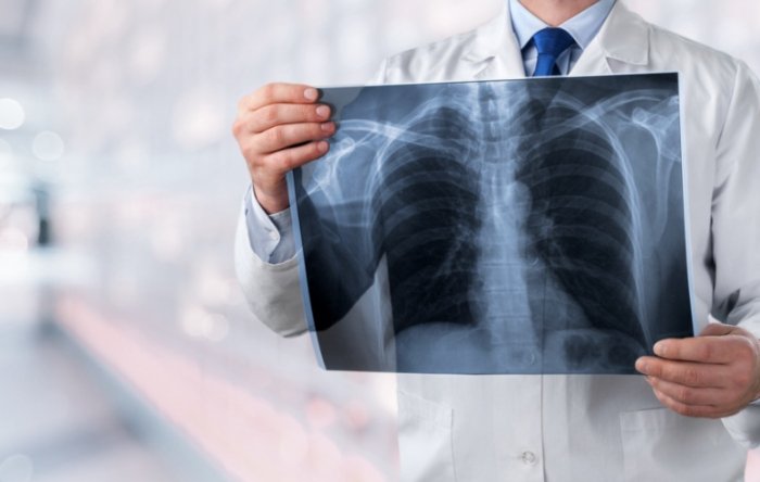 毛玻璃結節生長速度