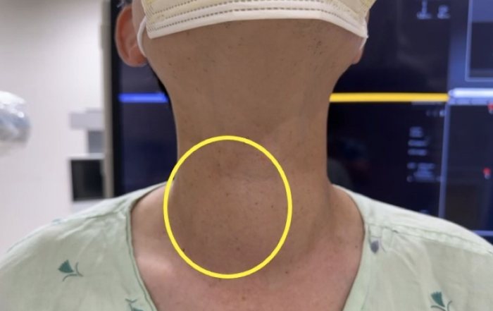 甲狀腺結節腫中醫