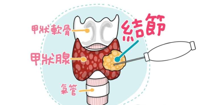 甲狀腺結節腫飲食治療