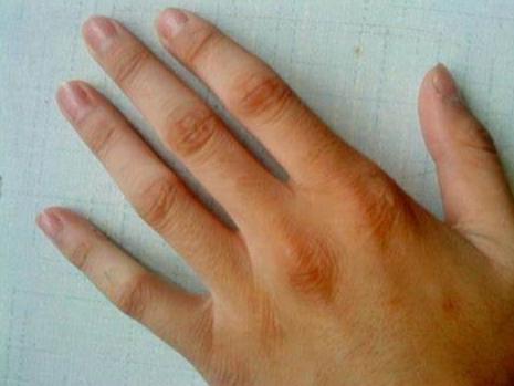 手指關節結節原因