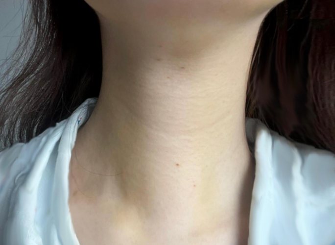 甲狀腺結節腫開刀費用