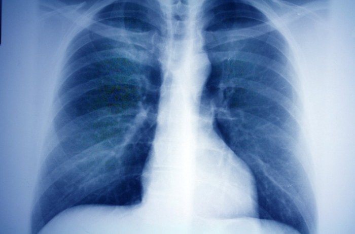 肺結節症狀 肺結節症狀