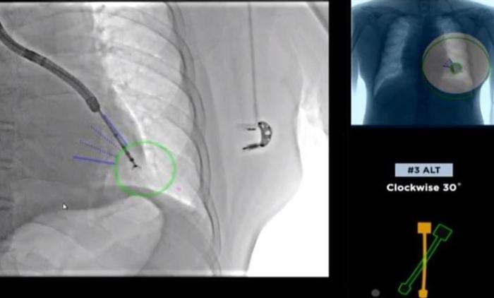肺部毛玻璃樣結節需開刀 肺部毛玻璃樣結節需開刀