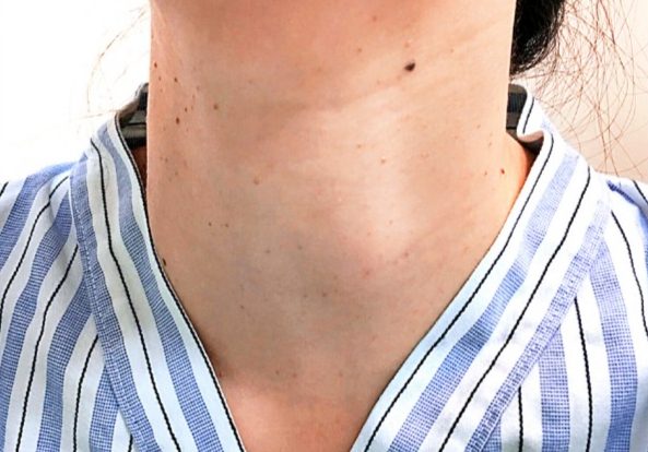 甲狀腺結節腫開刀費用