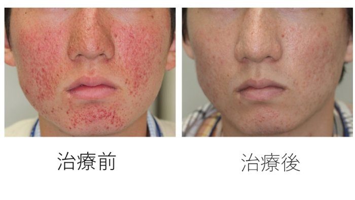 結節性硬化症病因 結節性硬化症病因