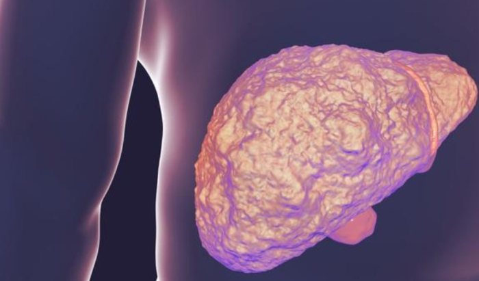 肝臟結節症狀 肝臟結節症狀