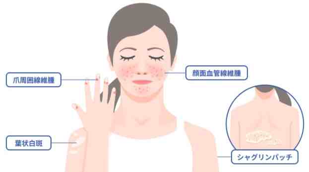 結節性硬化症治療 結節性硬化症治療