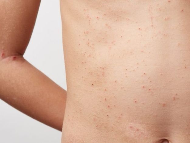 結節性硬化症症狀 結節性硬化症症狀