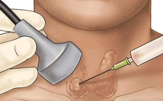 甲狀腺結節手術休息時間 甲狀腺結節手術休息時間