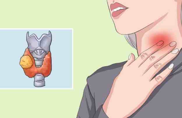 甲狀腺結節術後恢復 甲狀腺結節術後恢復