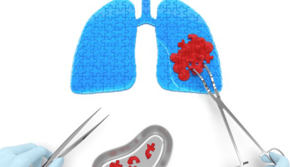 毛玻璃結節前兆 毛玻璃結節前兆