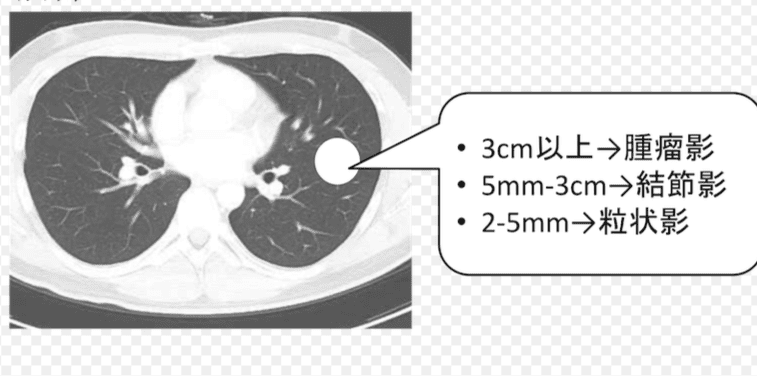 肺結節原因 肺結節原因