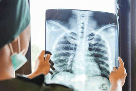 中醫治療肺結節 中醫治療肺結節