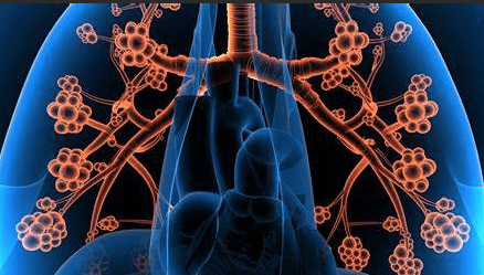 肺結節治療方法 肺結節治療方法