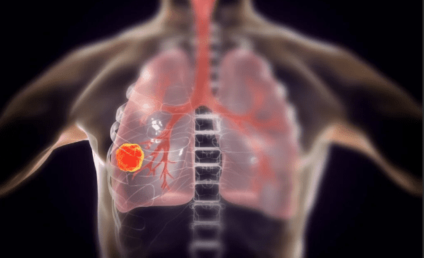 肺結節基本信息 肺結節基本信息