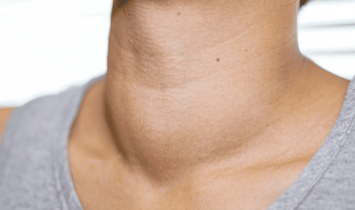 甲狀腺結節是什麼