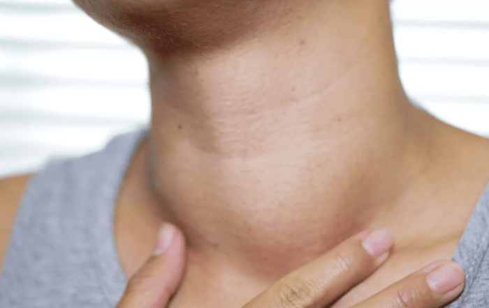 甲狀腺結節高危險族群