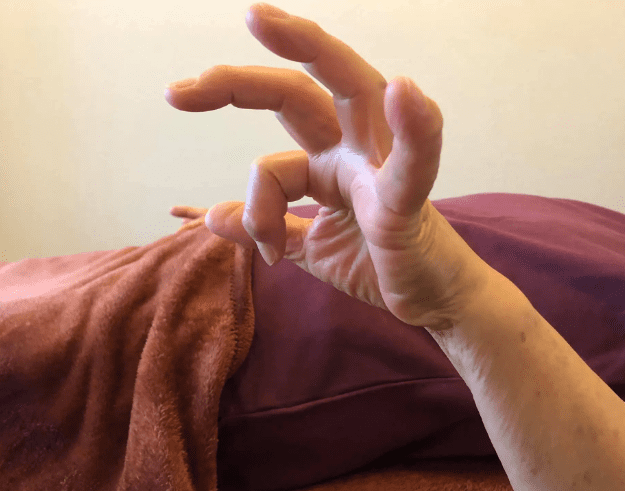 毛玻璃結節治療方法 毛玻璃結節治療方法