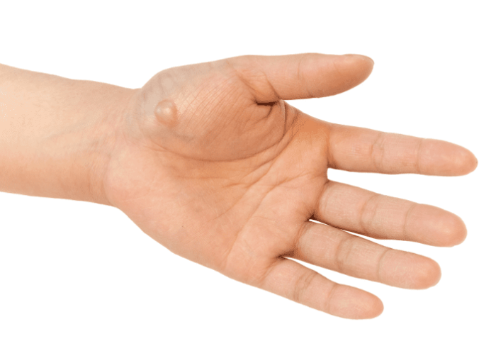 毛玻璃結節高危險族群 毛玻璃結節高危險族群