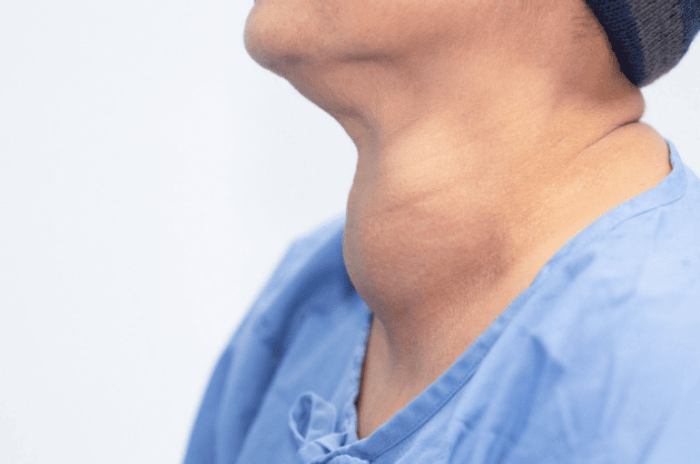 甲狀腺結節治療