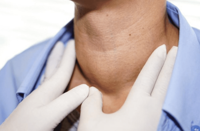 甲狀腺結節預防