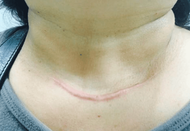 甲狀腺結節手術方式 甲狀腺結節手術方式