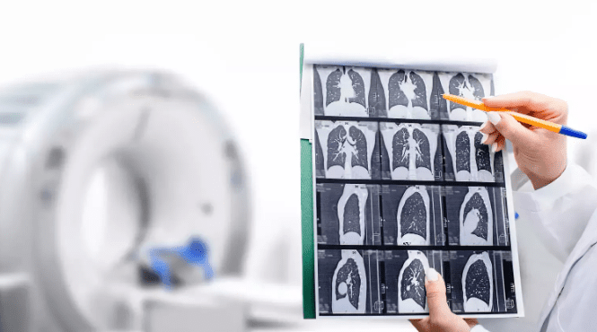 毛玻璃結節診斷